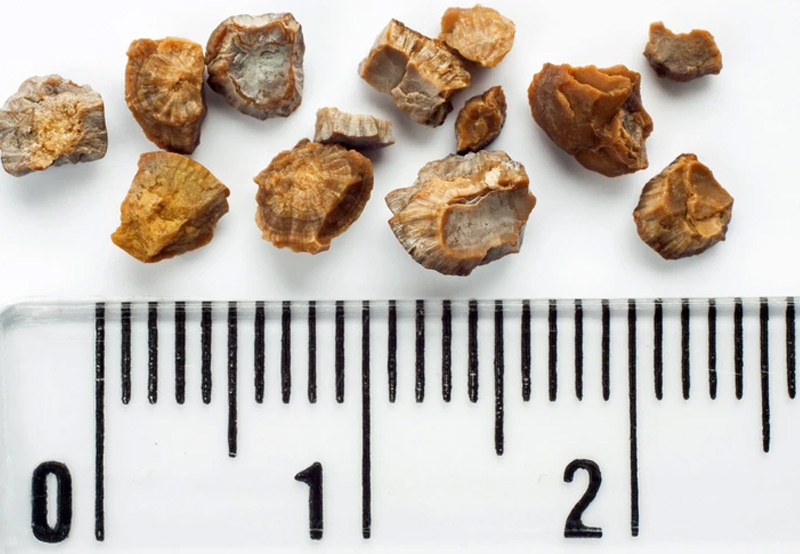 Kidney-stones-along-a-ruler-in-centimeters-Best-Urologist-in-California