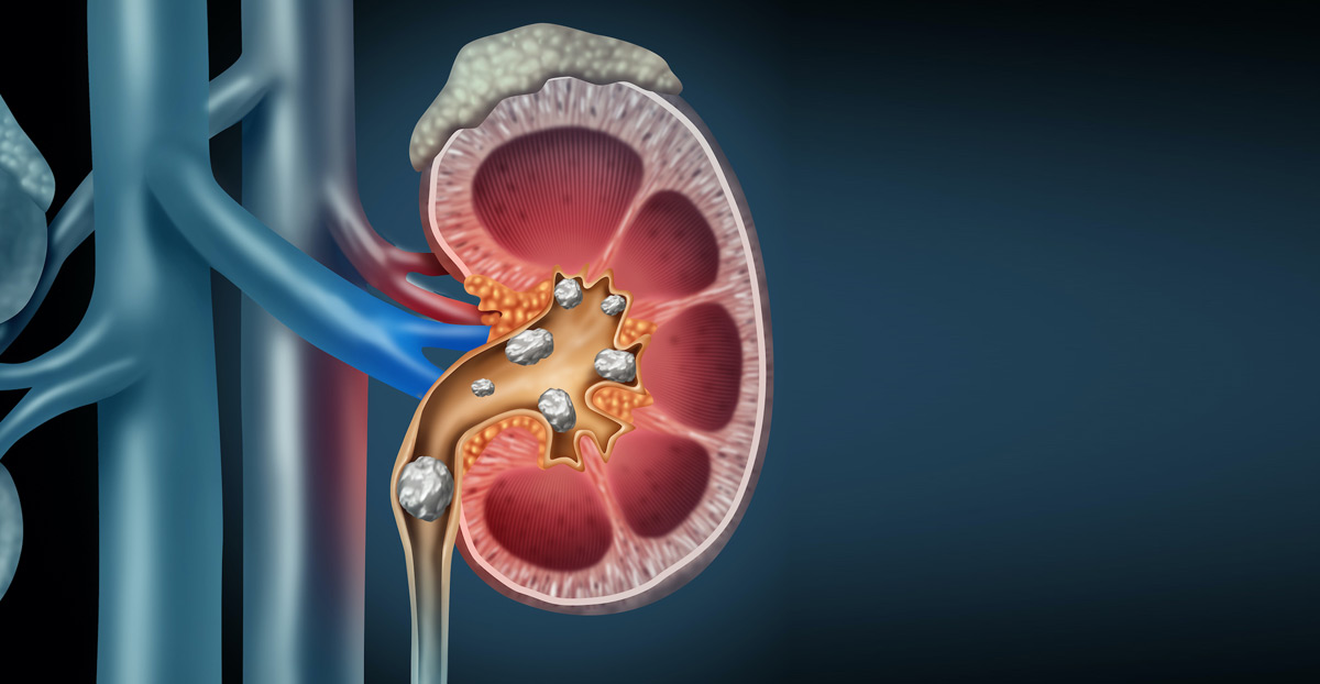 concept-of-kidney-stones-best-urologist-in-Orange-County